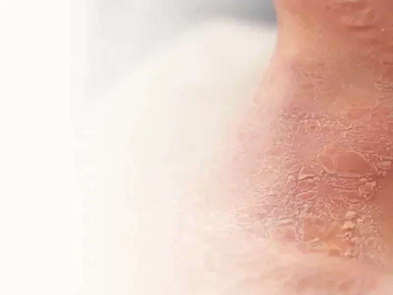 How to Care for Radiation-Sensitive Skin