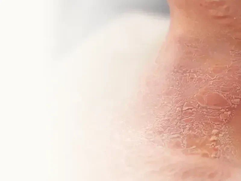 How to Care for Radiation-Sensitive Skin