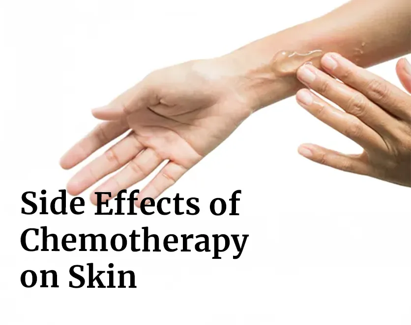 Side Effects of Chemotherapy on Skin: A Nurse’s Guide to Comfort & Care